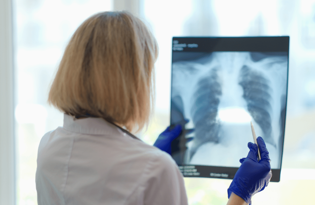 Doctor reading lung x ray of patient with pleural mesothelioma
