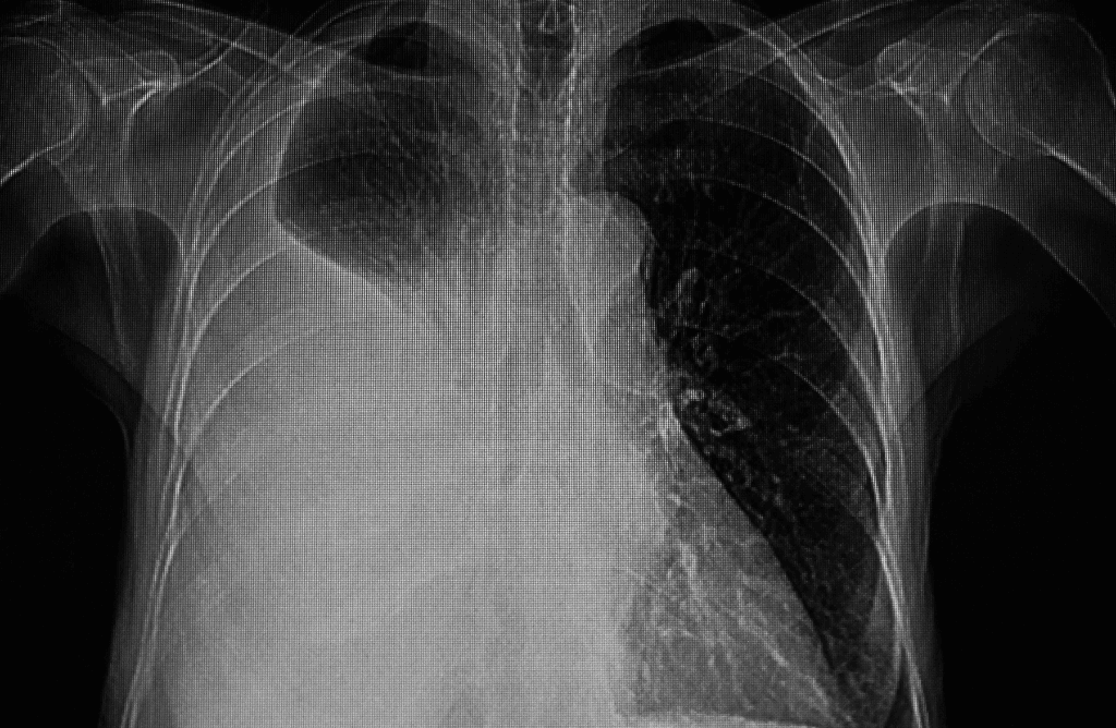 Photo of a lung scan of a person with pleural mesothelioma