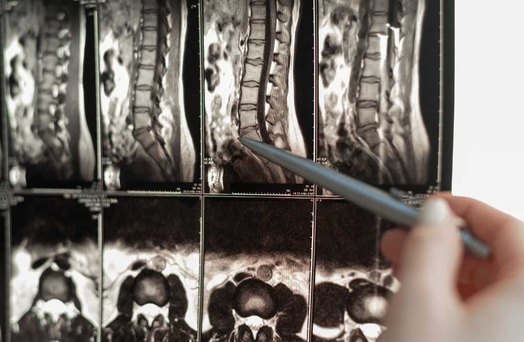Photo of a spinal cord x-ray