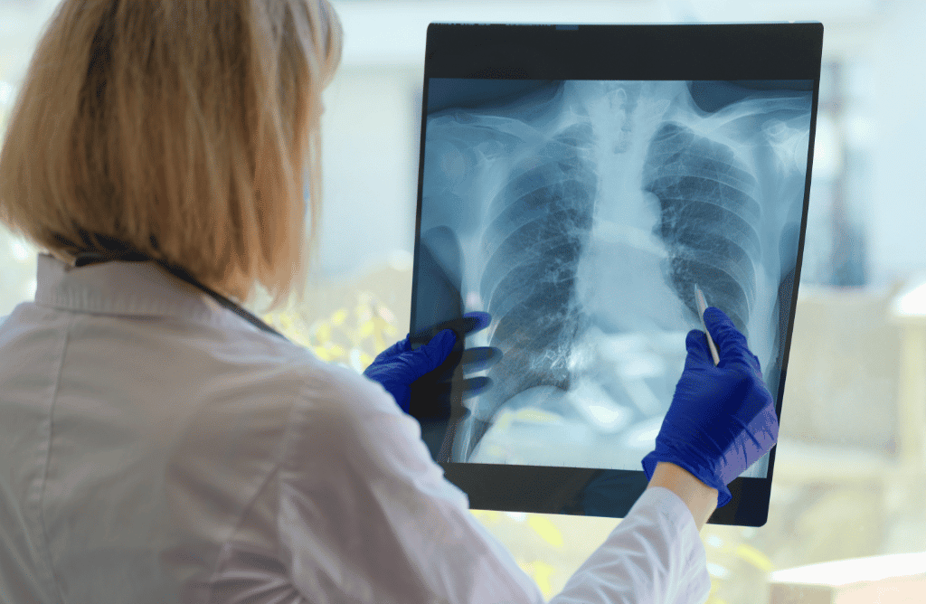 Doctor reading x-ray of mesothelioma patient