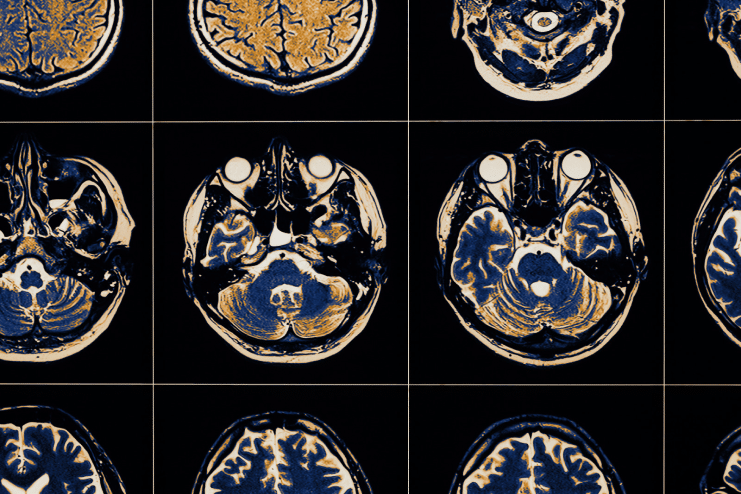 brain x-ray